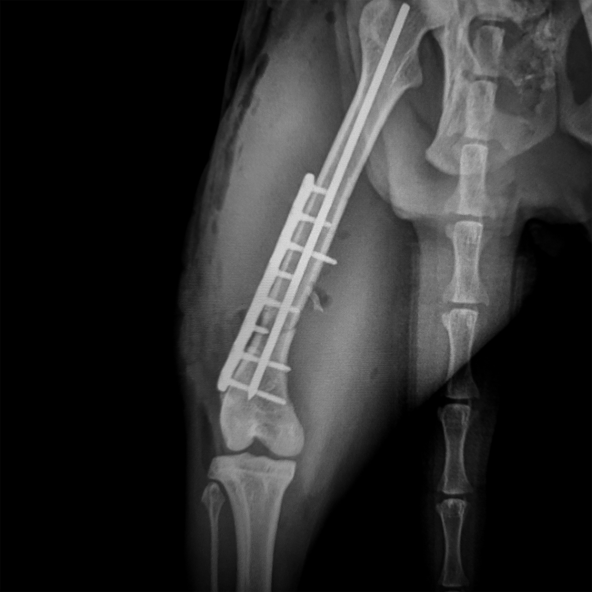 (USA) Fracture Management - Long Bones