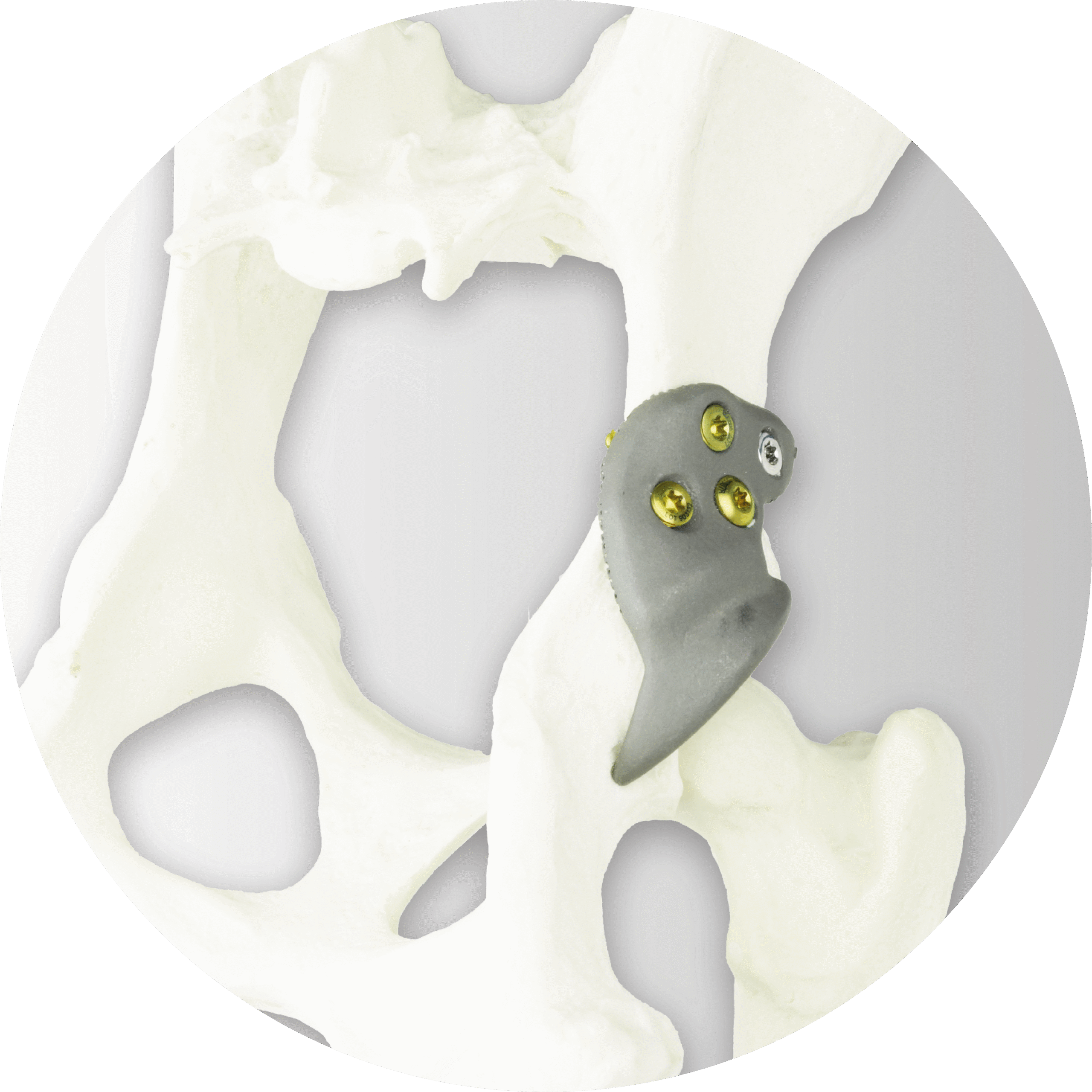 3D HIP Implant on Sawbone Model