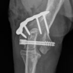 Applications for Headless Compression Screws