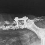 (ECVS) Spinal Course with the LeiPED Pedicle Screw System and LeiCAGE Intervertebral Cages