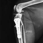 (WVOC) Cranial Closing Wedge Surgery