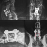 Exclusive 3-Day Spinal Surgery Course