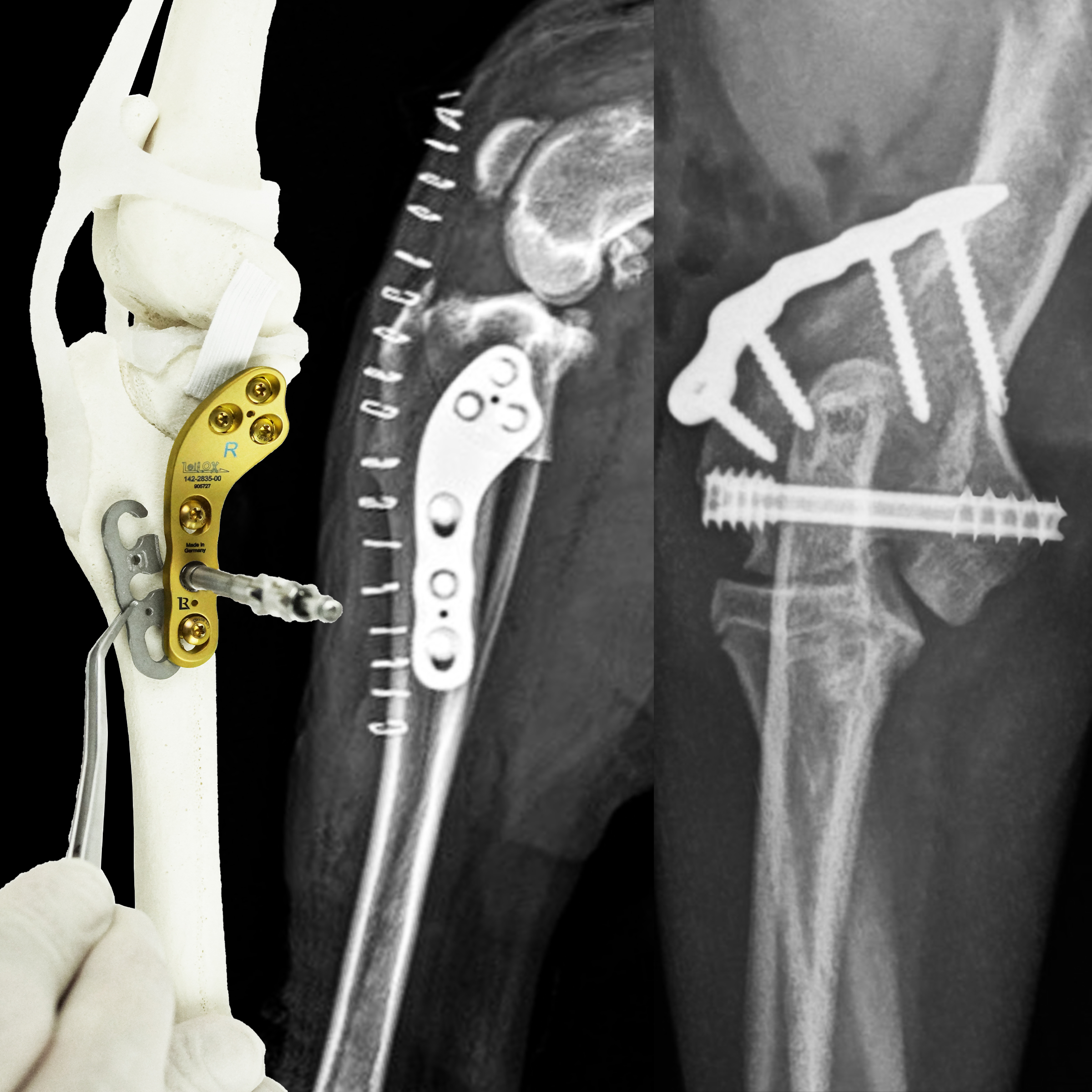 Advancements in Orthopedics - Headless Compression Screw Applications & TPLO with Patella Luxation Spacers