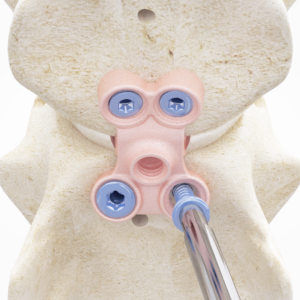 Spinal Surgery